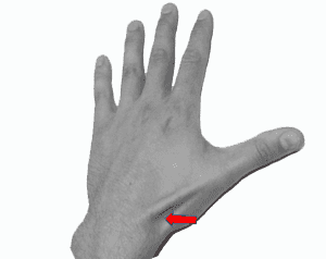 snuffbox tenderness scaphoid fracture
