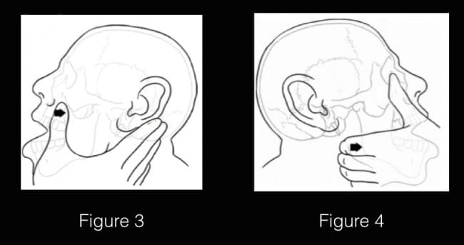 TMJpic3&4