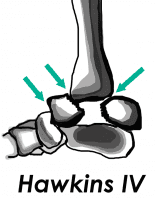 Ankle and Hindfoot Fractures Talar Neck Hawkins Classification IV