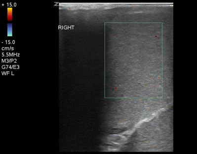 Figure 1. Ultrasound of the right testicle. No flow is seen with color doppler.