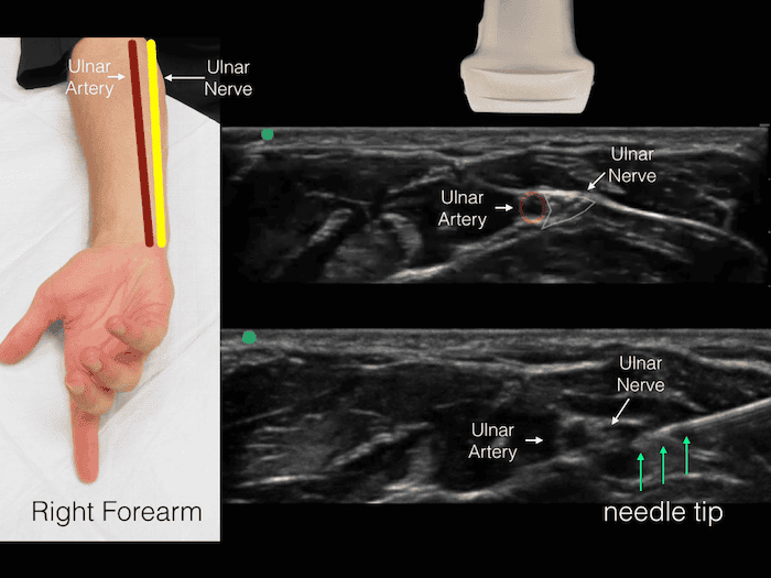 Ultrasound Ulnar Nerve 1