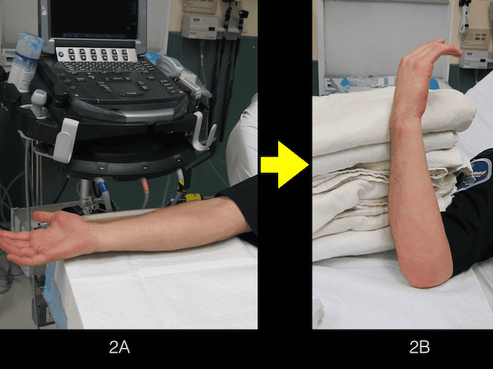 Ultrasound Ulnar Nerve 2