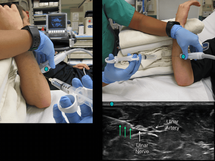 Ultrasound Ulnar Nerve 3