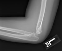 elbow injuries