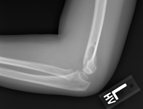 PV Card: Elbow Injuries
