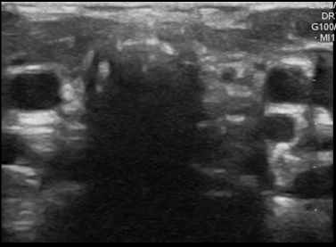 Ultrasound showing swirling air bubbles from endotracheal tube cuff (transverse view of the anterior neck)