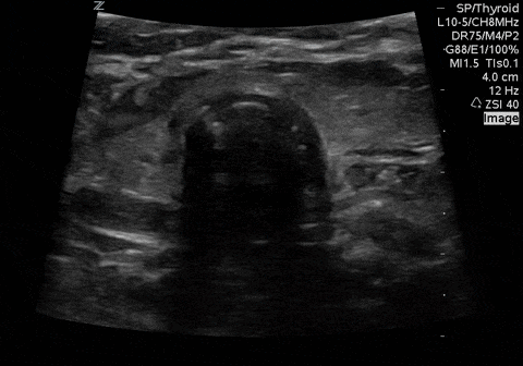 Video 2. Dynamic video showing placement of ETT into the esophagus (located in left paratracheal location in approx. 70% humans).