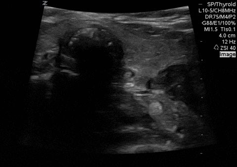 Video 1. Dynamic (real-time, concurrent with laryngoscopy and ETT placement) video showing successful tracheal placement of ETT.
