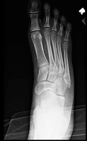 fifth metatarsal fracture.jpg