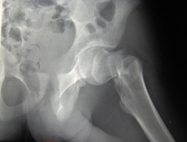 hip fx