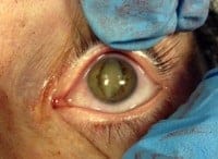 lens dislocation