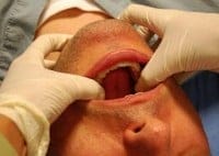 mandible dislocation