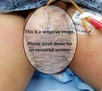 painful-scrotal-swelling-censored-350