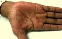 palmar rash